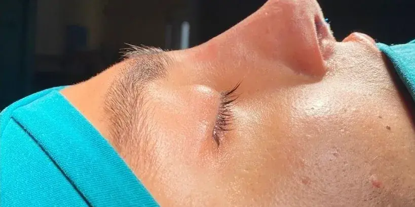 Case 1, the same nose at the end of the operation.