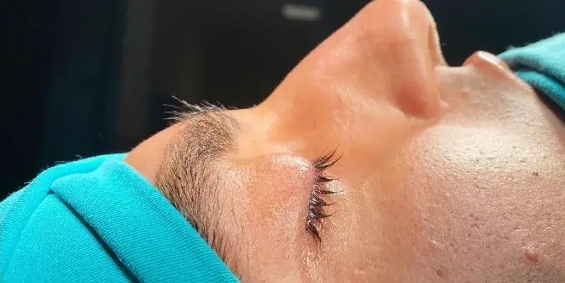 Case 1, the nose in profile before the operation.