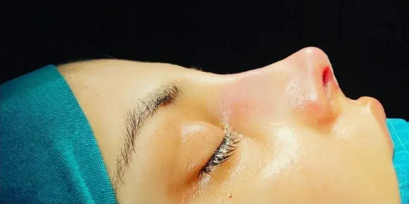 Case 2, the same nose at the end of the operation.
