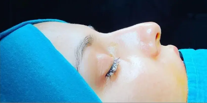Case 2, the nose in profile before the operation.