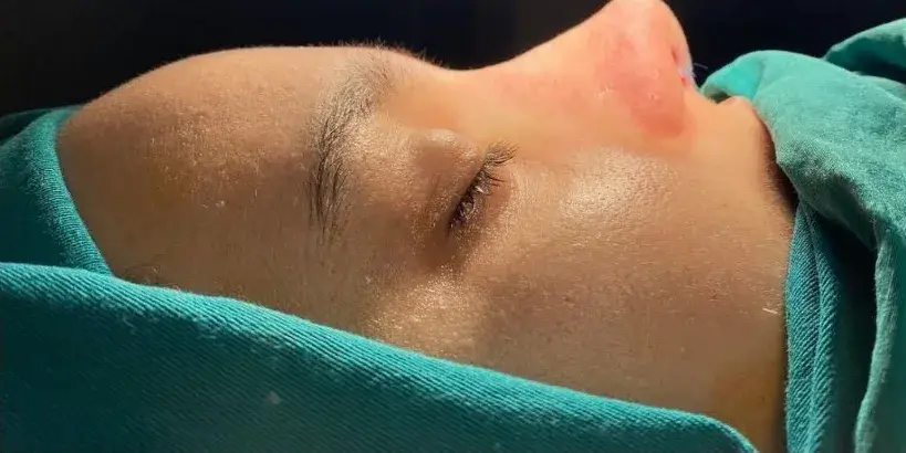 Case 3, the same nose at the end of the operation.