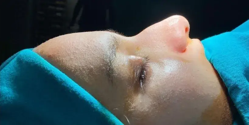 Case 3, the nose in profile before the operation.