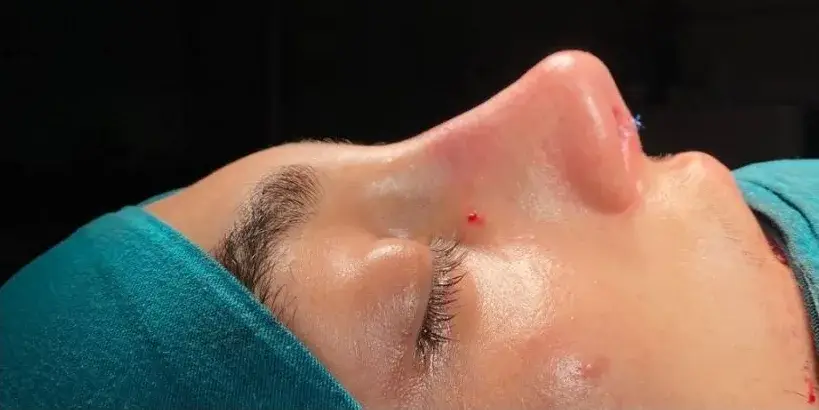 Case 4, the same nose at the end of the operation.