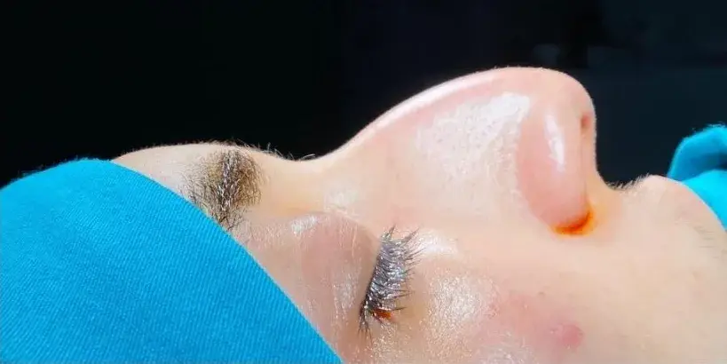 Case 4, the nose in profile before the operation.