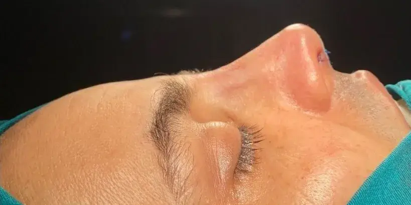 Case 5, the same nose at the end of the operation.