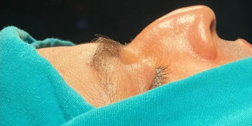 Case 5, the nose in profile before the operation.