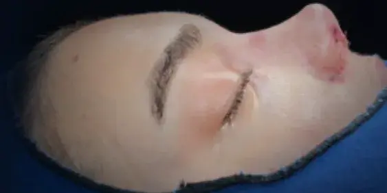 Case 1, the same nose at the end of the operation.