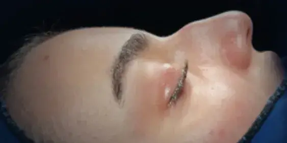Case 1, the nose in profile before the operation.