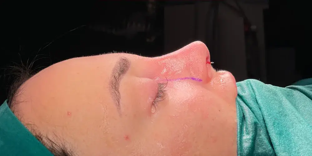 Case 1, the same nose at the end of the operation.