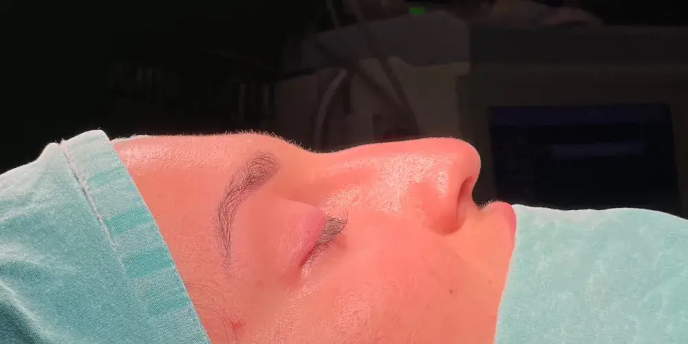 Case 1, the nose in profile before the operation.