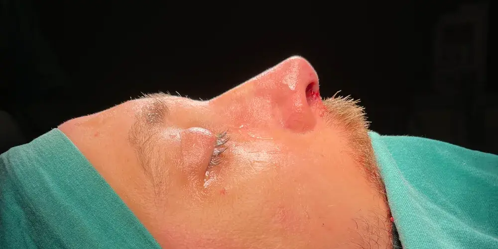 Case 2, the same nose at the end of the operation.