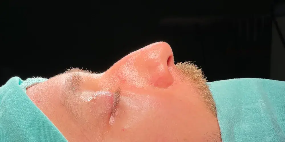 Case 2, the nose in profile before the operation.