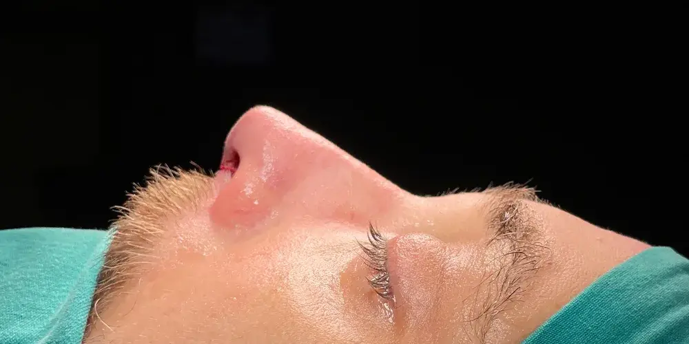 Case 3, the same nose at the end of the operation.