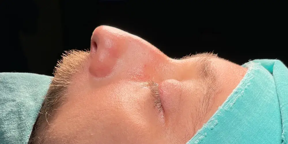 Case 3, the nose in profile before the operation.