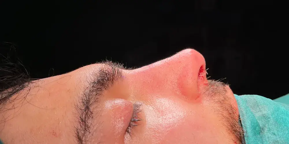 Case 4, the same nose at the end of the operation.