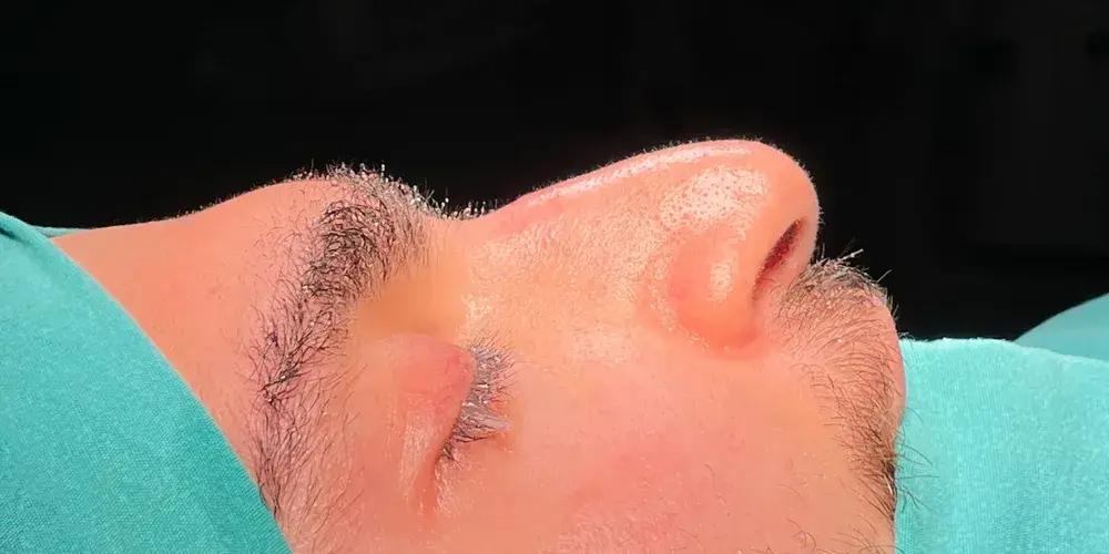 Case 4, the nose in profile before the operation.