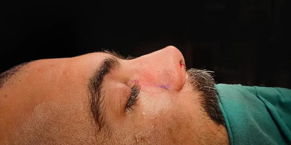 Case 5, the same nose at the end of the operation.
