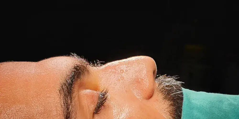 Case 5, the nose in profile before the operation.