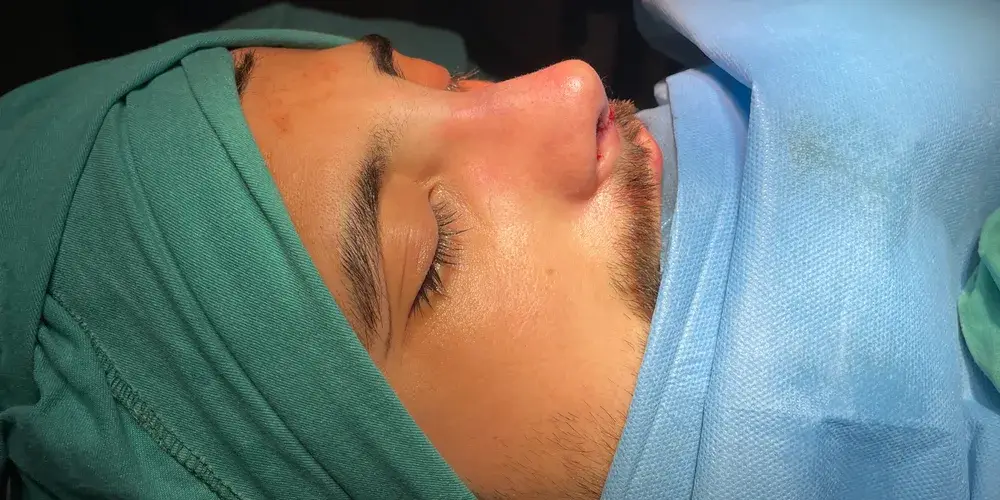 Case 1, the same nose at the end of the operation.