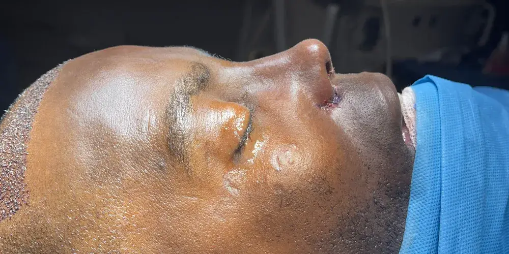 Case 2, the same nose at the end of the operation.