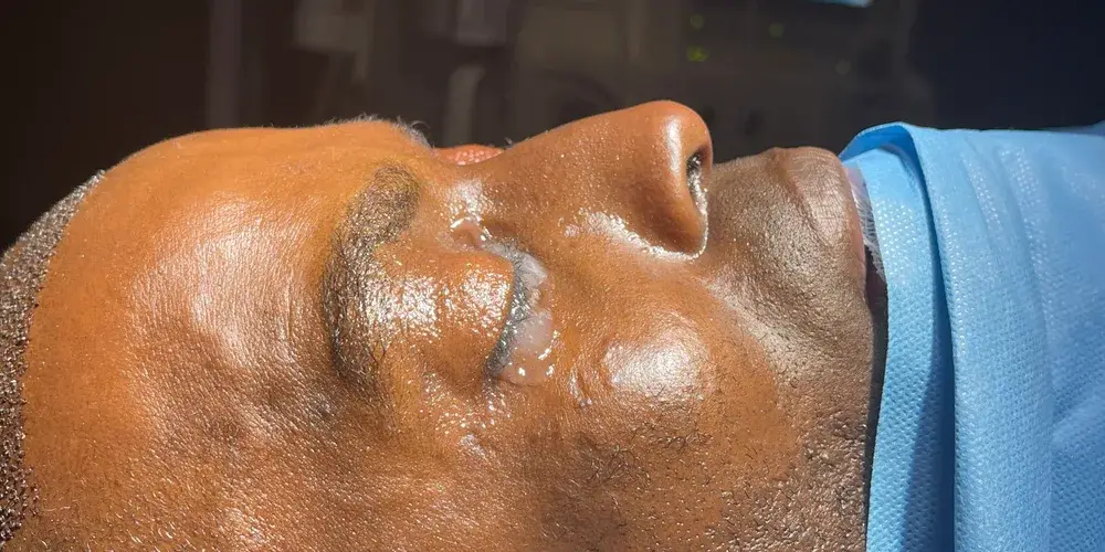 Case 2, the nose in profile before the operation.