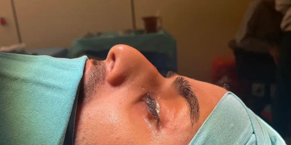 Case 3, the nose in profile before the operation.