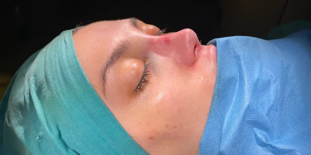 Case 4, the same nose at the end of the operation.