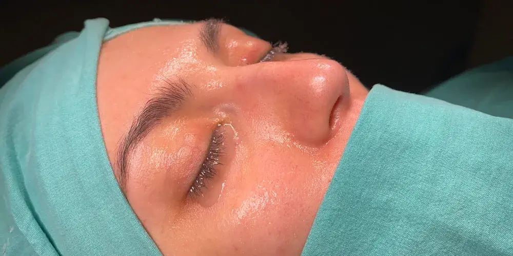 Case 4, the nose in profile before the operation.