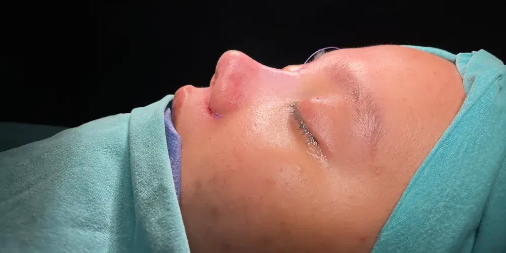Case 5, the same nose at the end of the operation.