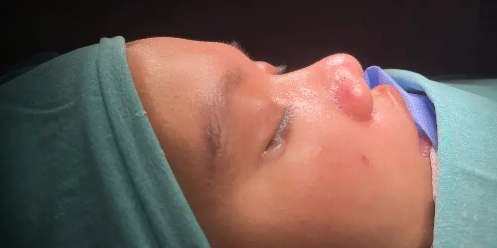 Case 5, the nose in profile before the operation.