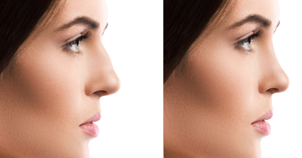 Women before and after piezo rhinoplasty Istanbul.