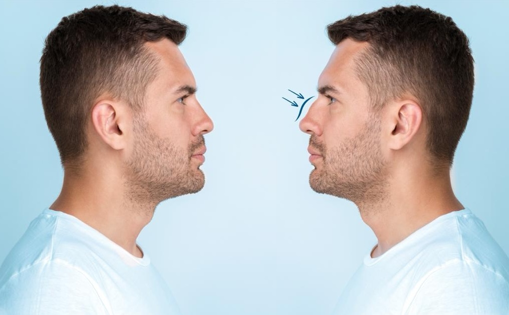 Rhinoplasty
Nose Job