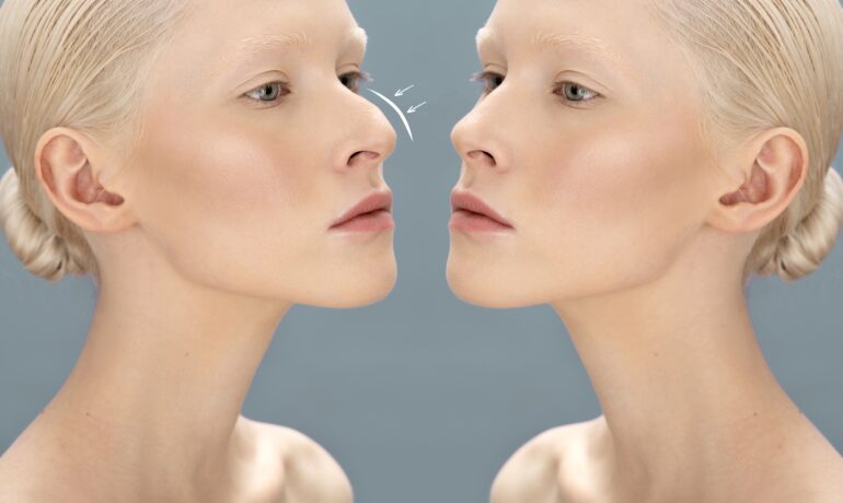 after rhinoplasty collapse
